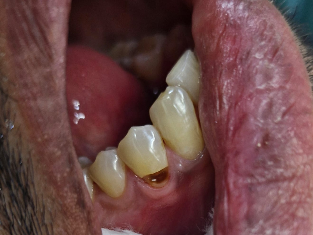 Before Cavity